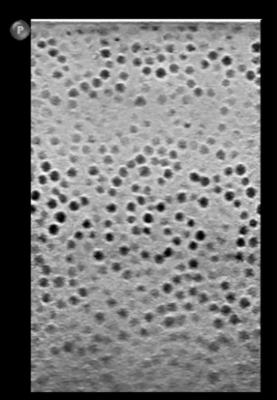 Ultrasound comparison showing a dead zone created by a focal-zone change